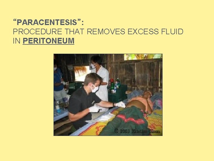 “PARACENTESIS”: PROCEDURE THAT REMOVES EXCESS FLUID IN PERITONEUM  “PARACENTESIS”: PROCEDURE THAT REMOVES EXCESS FLUID IN PERITONEUM