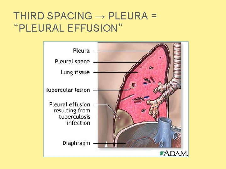THIRD SPACING → PLEURA = “PLEURAL EFFUSION”  THIRD SPACING → PLEURA = “PLEURAL EFFUSION”