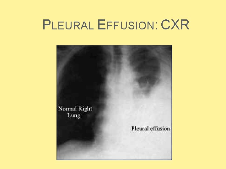PLEURAL EFFUSION: CXR  PLEURAL EFFUSION: CXR