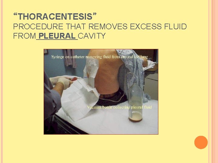 “THORACENTESIS” PROCEDURE THAT REMOVES EXCESS FLUID FROM PLEURAL CAVITY  “THORACENTESIS” PROCEDURE THAT REMOVES EXCESS FLUID FROM PLEURAL CAVITY