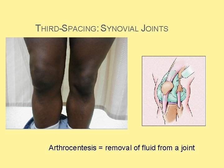 THIRD-SPACING: SYNOVIAL JOINTS Arthrocentesis = removal of fluid from a joint  THIRD-SPACING: SYNOVIAL JOINTS Arthrocentesis = removal of fluid from a joint