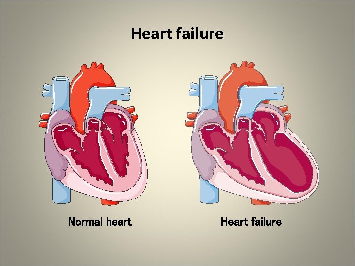 Heart failure Normal heart Heart failure 
