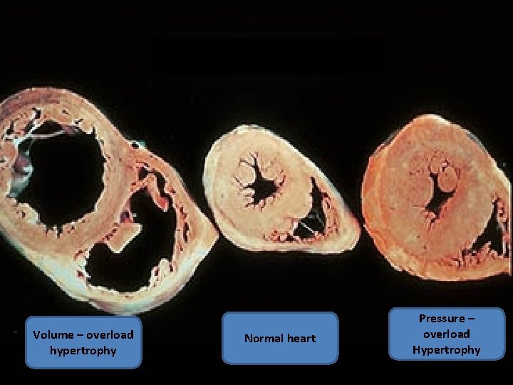 Volume – overload hypertrophy Normal heart Pressure – overload Hypertrophy 