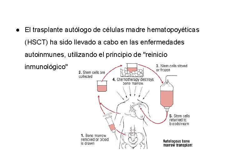 ● El trasplante autólogo de células madre hematopoyéticas (HSCT) ha sido llevado a cabo