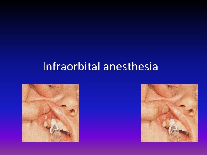 Infraorbital anesthesia 
