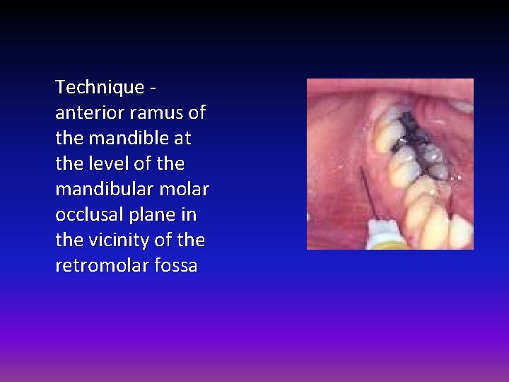 Technique - anterior ramus of the mandible at the level of the mandibular molar