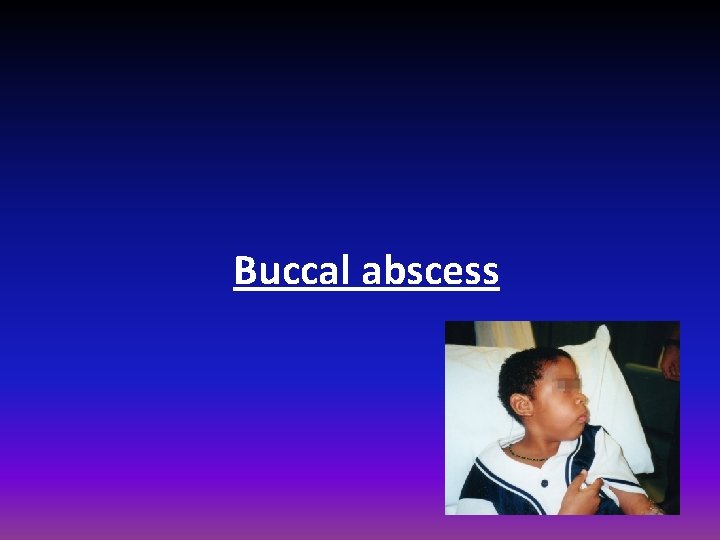 Buccal abscess 
