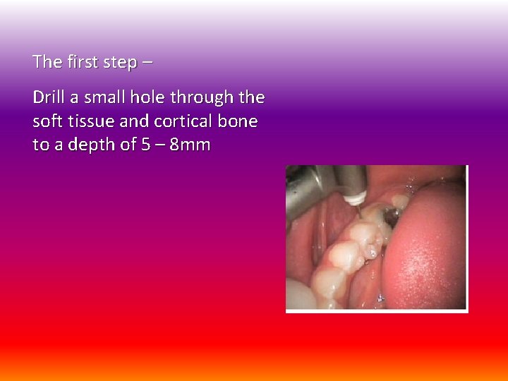 The first step – Drill a small hole through the soft tissue and cortical