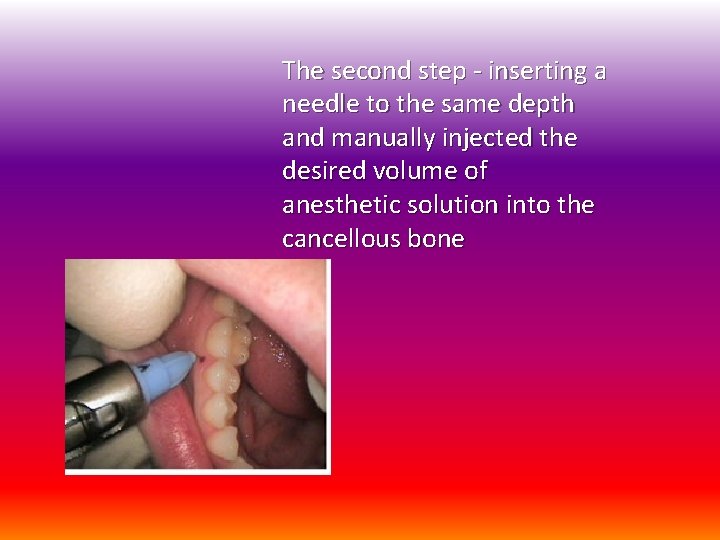 The second step - inserting a needle to the same depth and manually injected