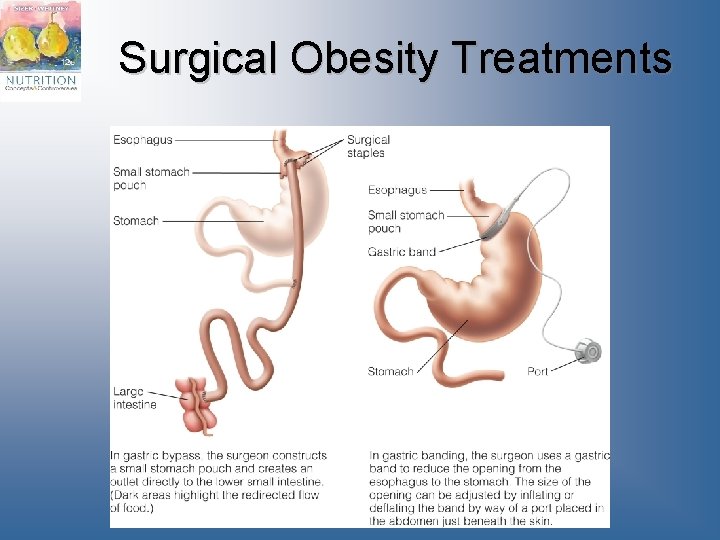 Surgical Obesity Treatments 