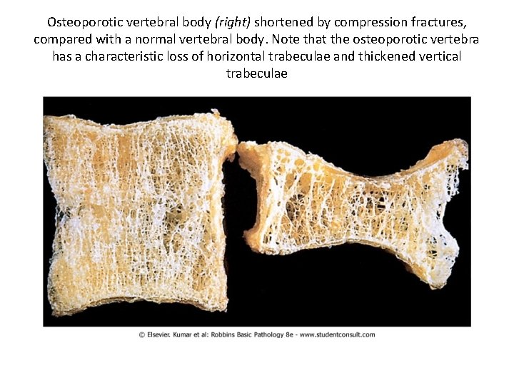 Osteoporotic vertebral body (right) shortened by compression fractures, compared with a normal vertebral body.