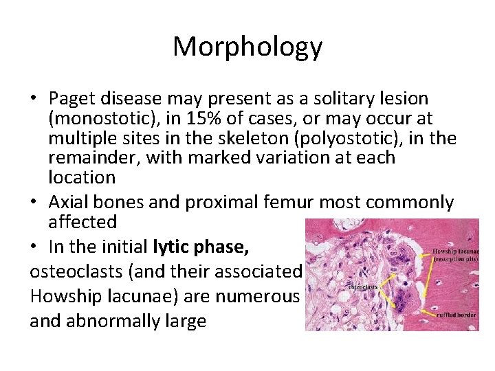 Morphology • Paget disease may present as a solitary lesion (monostotic), in 15% of