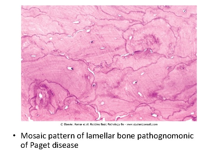  • Mosaic pattern of lamellar bone pathognomonic of Paget disease 