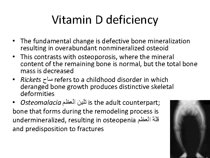 Vitamin D deficiency • The fundamental change is defective bone mineralization resulting in overabundant