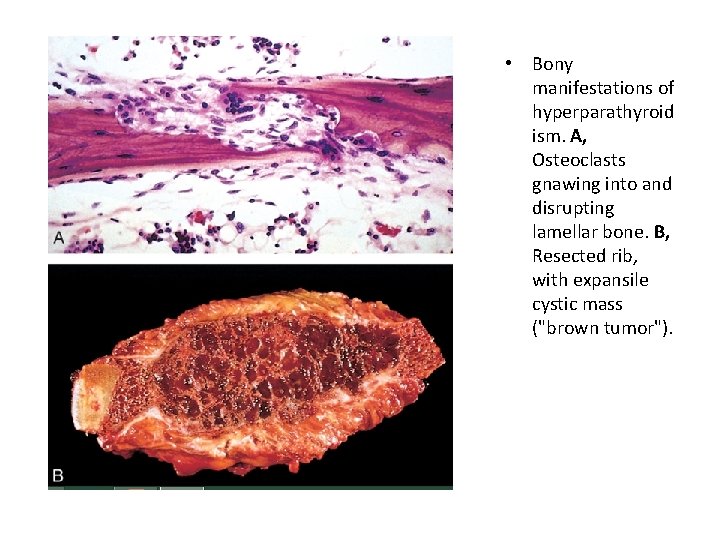  • Bony manifestations of hyperparathyroid ism. A, Osteoclasts gnawing into and disrupting lamellar