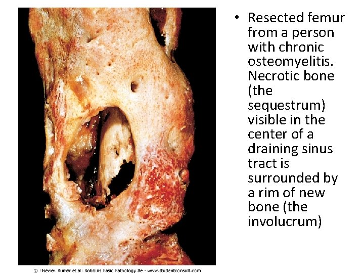  • Resected femur from a person with chronic osteomyelitis. Necrotic bone (the sequestrum)