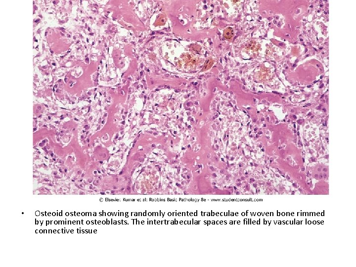  • Osteoid osteoma showing randomly oriented trabeculae of woven bone rimmed by prominent