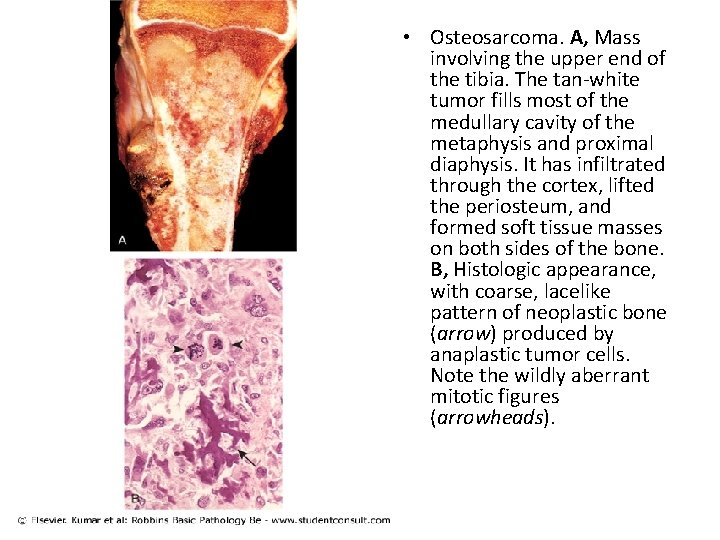  • Osteosarcoma. A, Mass involving the upper end of the tibia. The tan-white