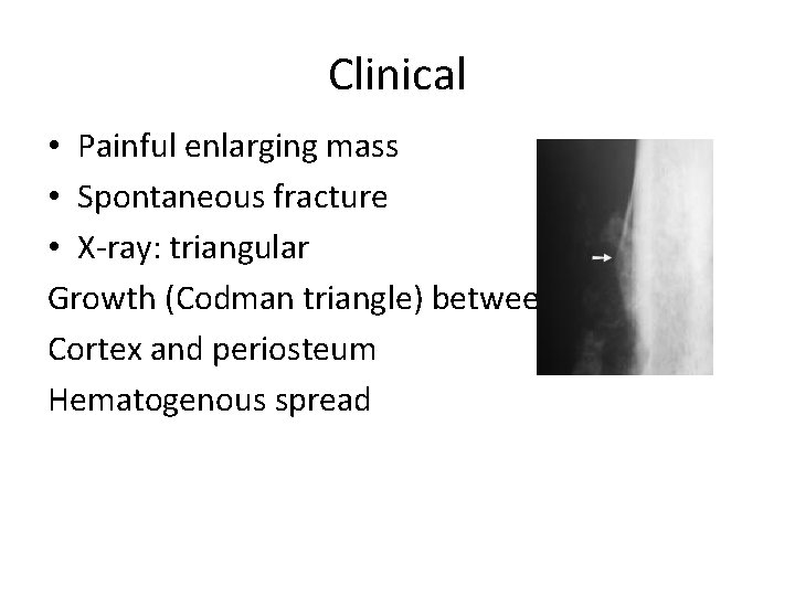 Clinical • Painful enlarging mass • Spontaneous fracture • X-ray: triangular Growth (Codman triangle)