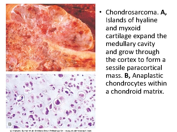  • Chondrosarcoma. A, Islands of hyaline and myxoid cartilage expand the medullary cavity