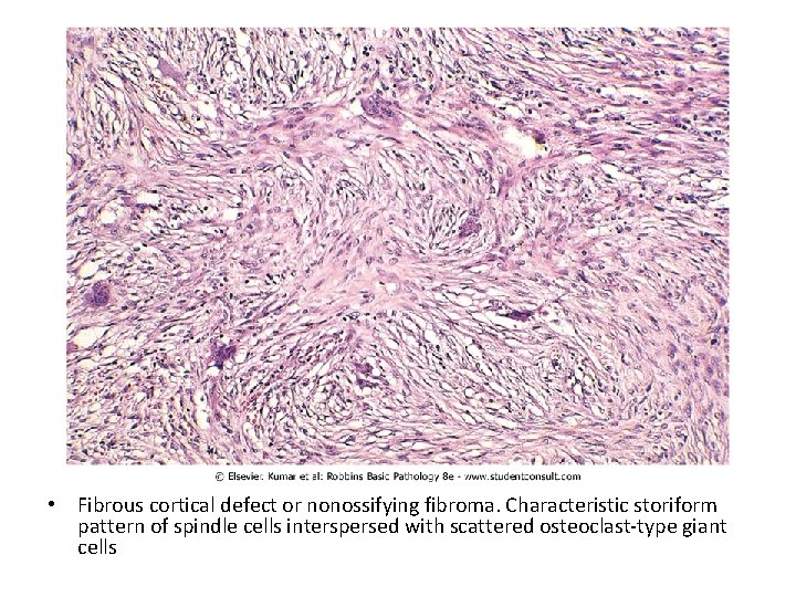  • Fibrous cortical defect or nonossifying fibroma. Characteristic storiform pattern of spindle cells