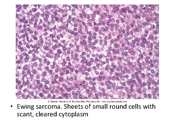  • Ewing sarcoma. Sheets of small round cells with scant, cleared cytoplasm 