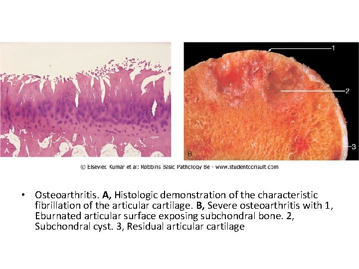  • Osteoarthritis. A, Histologic demonstration of the characteristic fibrillation of the articular cartilage.