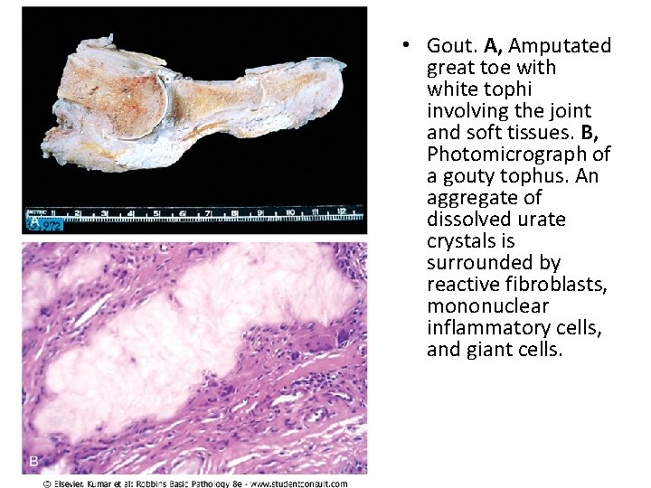  • Gout. A, Amputated great toe with white tophi involving the joint and