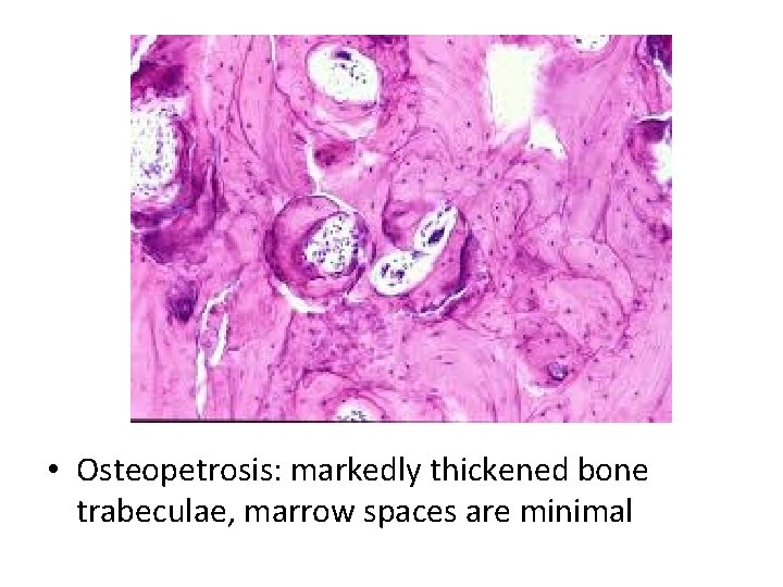  • Osteopetrosis: markedly thickened bone trabeculae, marrow spaces are minimal 