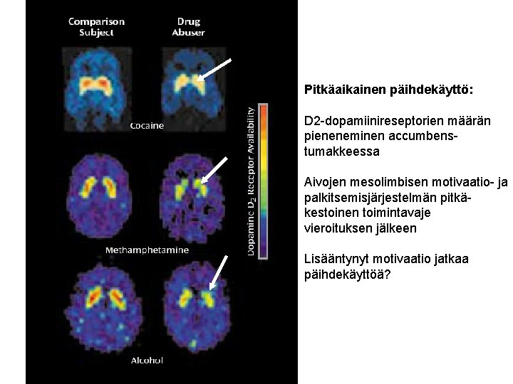 Pitkäaikainen päihdekäyttö: D 2 -dopamiinireseptorien määrän pieneneminen accumbenstumakkeessa Aivojen mesolimbisen motivaatio- ja palkitsemisjärjestelmän pitkäkestoinen