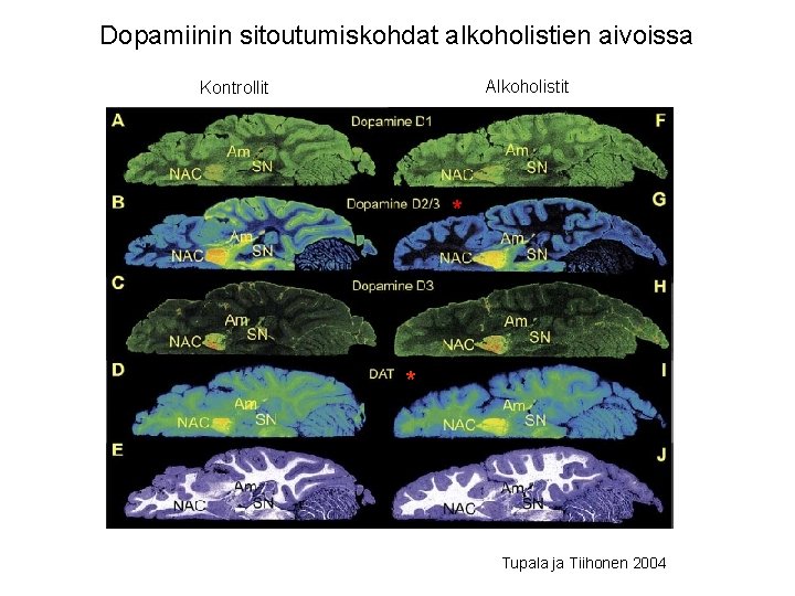 Dopamiinin sitoutumiskohdat alkoholistien aivoissa Alkoholistit Kontrollit * * Tupala ja Tiihonen 2004 