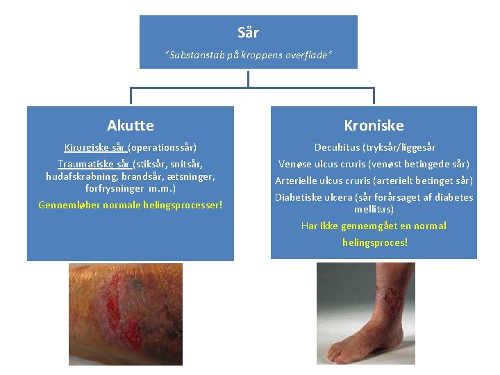 Sår ”Substanstab på kroppens overflade” Akutte Kroniske Kirurgiske sår (operationssår) Decubitus (tryksår/liggesår Traumatiske sår
