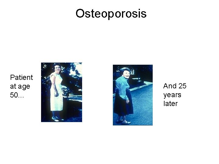 Osteoporosis Patient at age 50. . . And 25 years later 