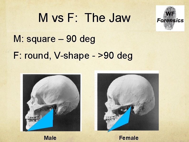 M vs F: The Jaw M: square – 90 deg F: round, V-shape -