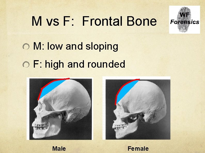 M vs F: Frontal Bone M: low and sloping F: high and rounded Male