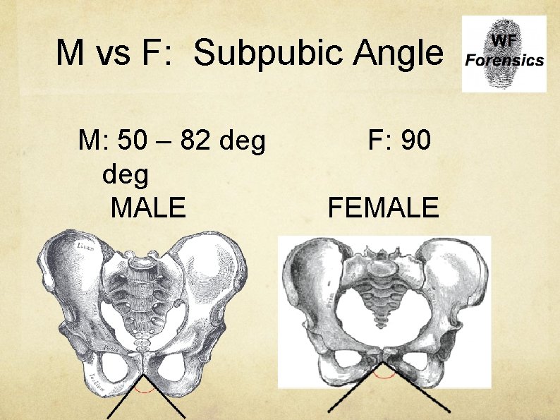 M vs F: Subpubic Angle M: 50 – 82 deg MALE F: 90 FEMALE
