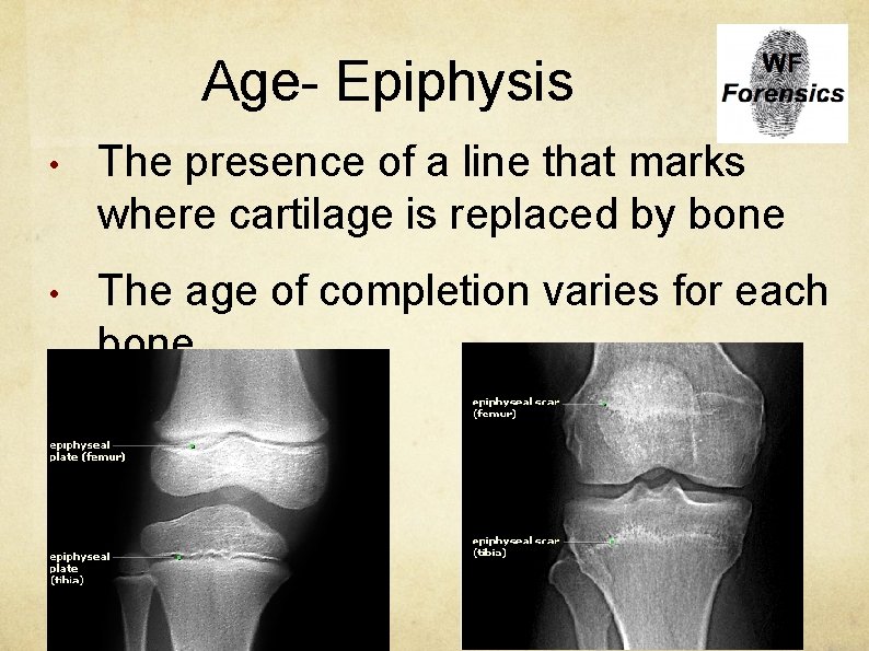 Age- Epiphysis • The presence of a line that marks where cartilage is replaced