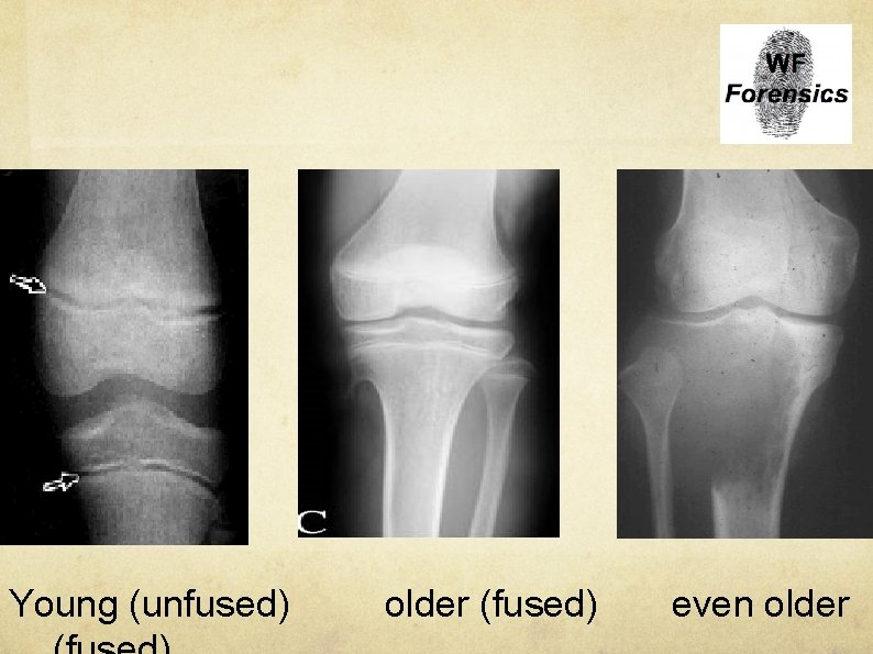 Young (unfused) older (fused) even older 