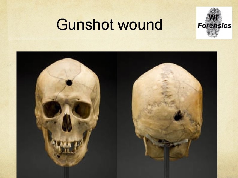 Gunshot wound 