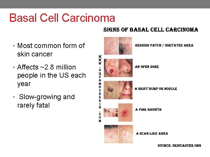 Basal Cell Carcinoma • Most common form of skin cancer • Affects ~2. 8