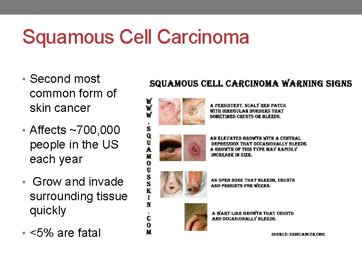 Squamous Cell Carcinoma • Second most common form of skin cancer • Affects ~700,