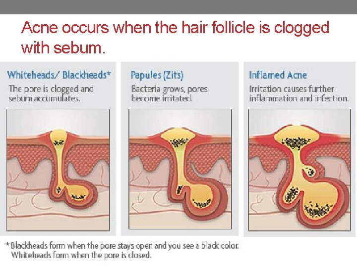 Acne occurs when the hair follicle is clogged with sebum. 