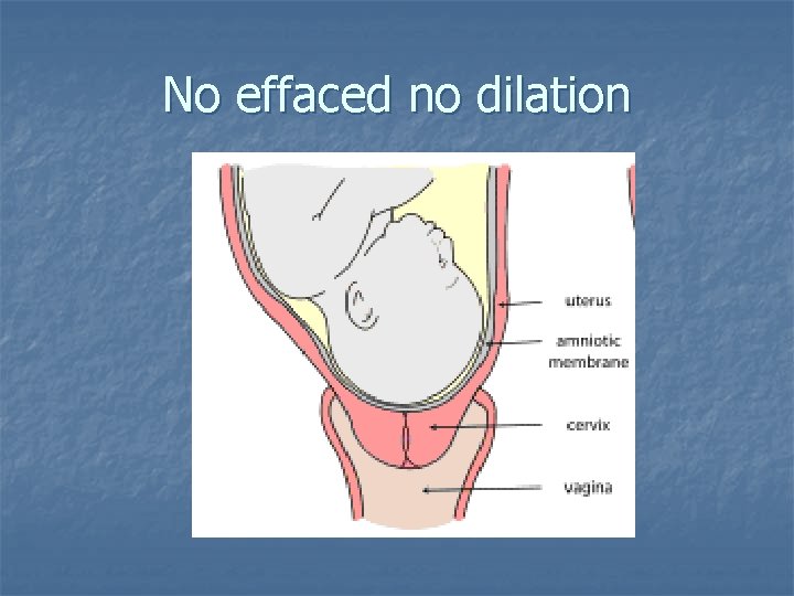 No effaced no dilation 