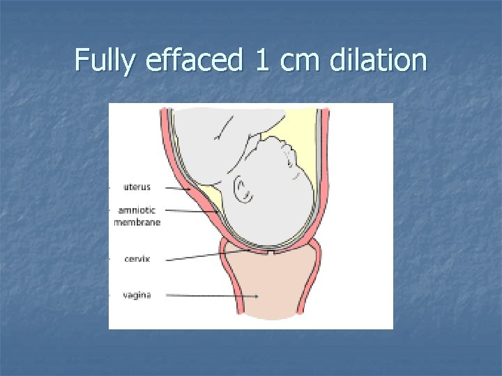 Fully effaced 1 cm dilation 