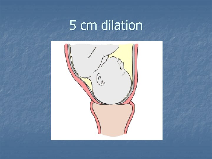 5 cm dilation 
