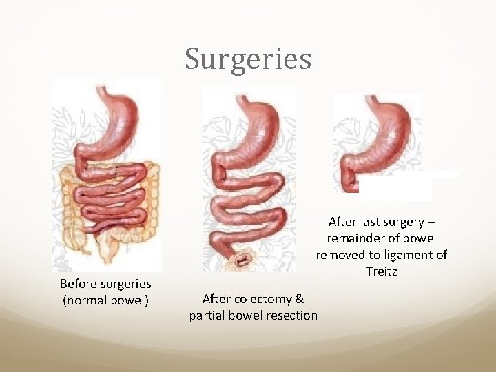 Surgeries Before surgeries (normal bowel) After last surgery – remainder of bowel removed to