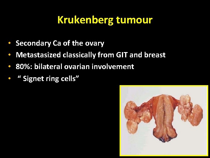 Krukenberg tumour • • Secondary Ca of the ovary Metastasized classically from GIT and