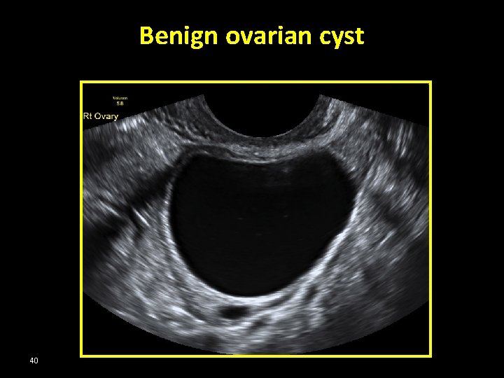 Benign ovarian cyst 40 