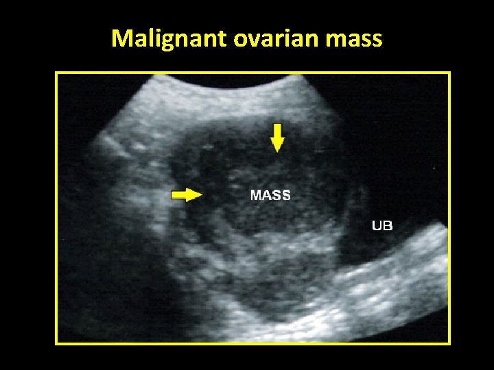 Malignant ovarian mass 