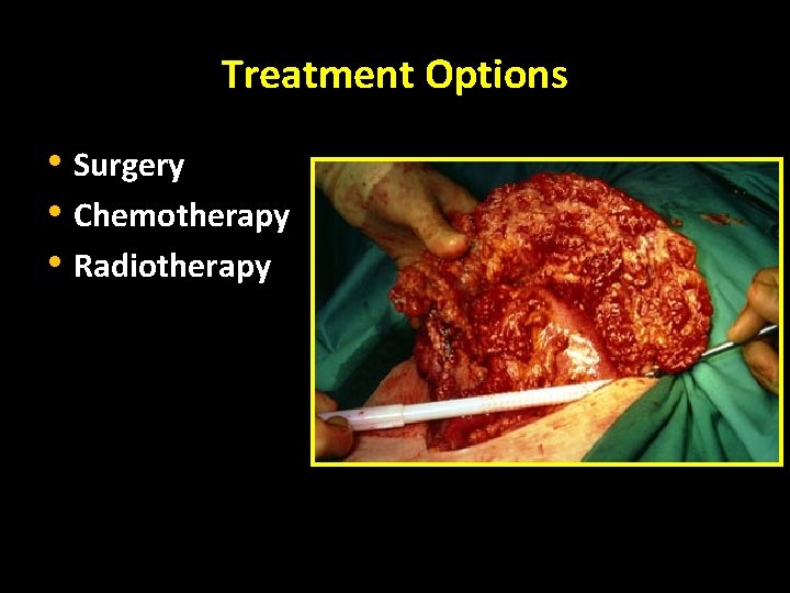 Treatment Options • Surgery • Chemotherapy • Radiotherapy 